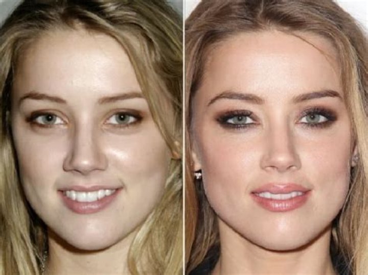 Amber Heard Plastic Surgery Before and After